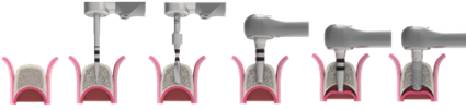 expansores óseos ziacom timelapse