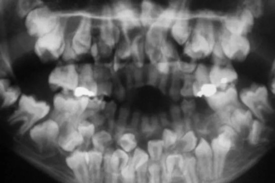 hiperdoncia múltiple